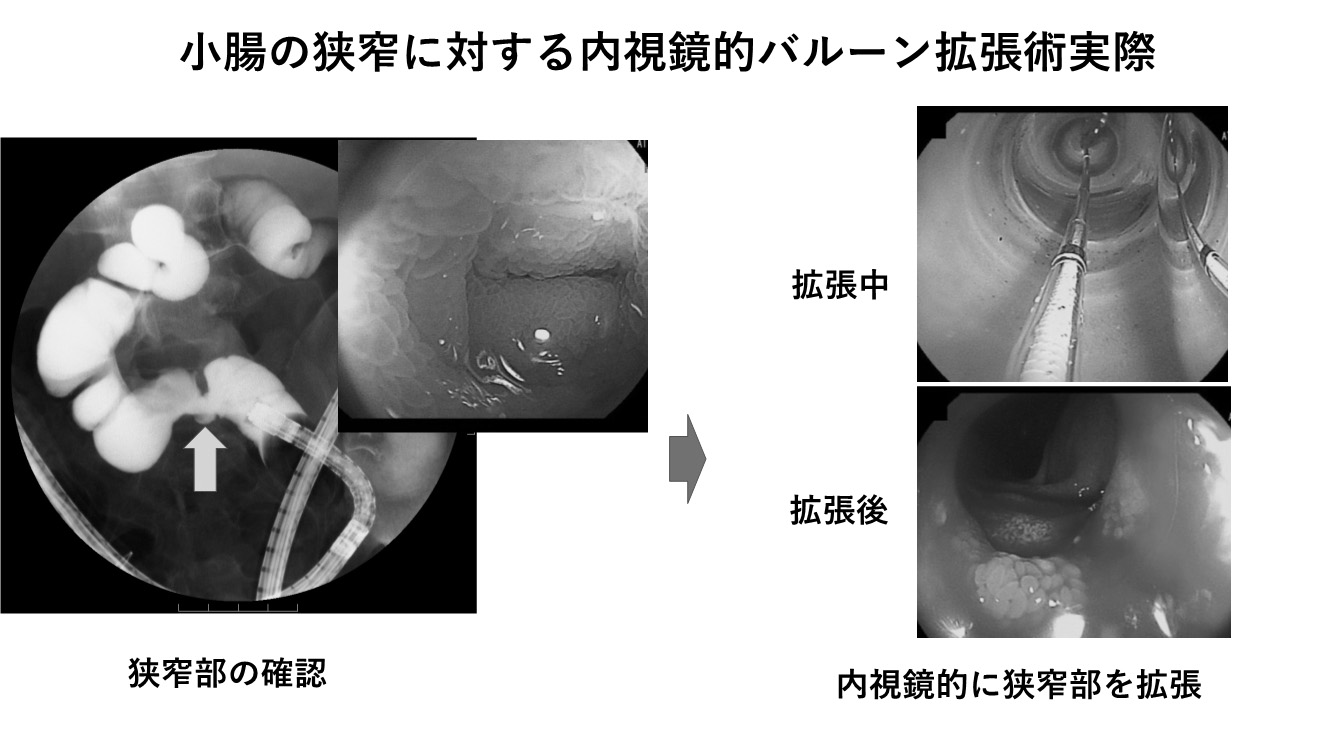 /upload/content/page/crohn6g.jpg